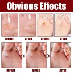 Feet Corn Removal Serum Ml