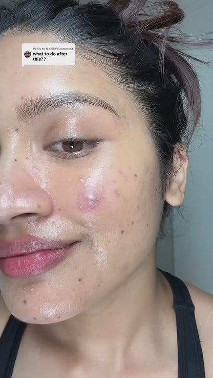 Acne Clearing Pimple Patches